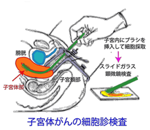 子宮内膜スメア